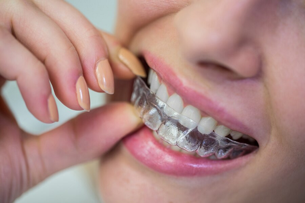 Teeth Alignment
