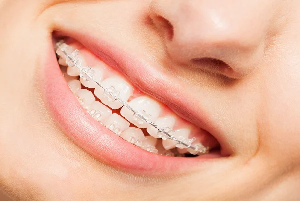 Ceramic Braces