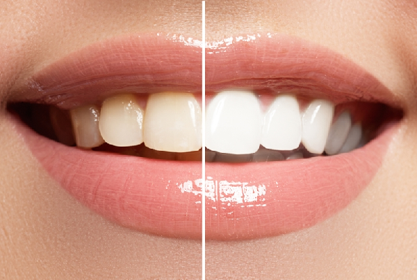 Teeth Cleaning