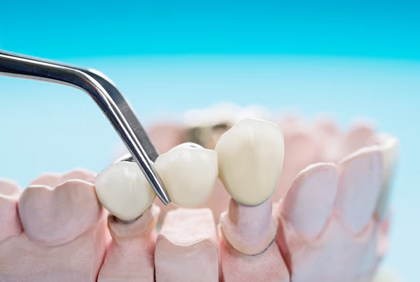 Teeth Replacement