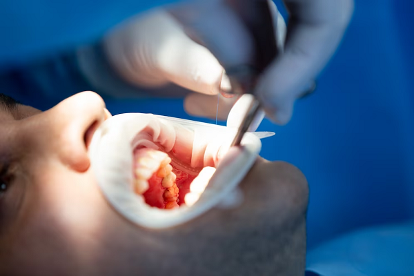 Wisdom Tooth Surgery